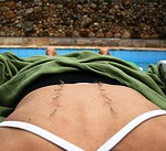 acupuncture back pain
